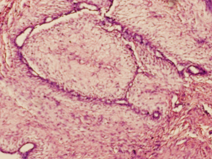 Figure 1: Photomicrograph showing fibroadenoma